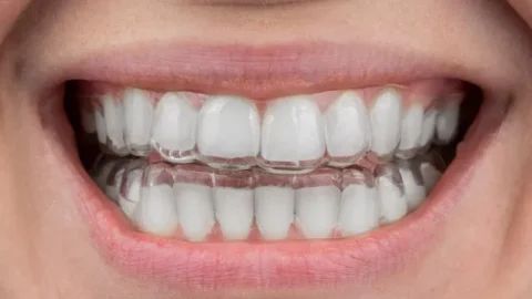 Aligners