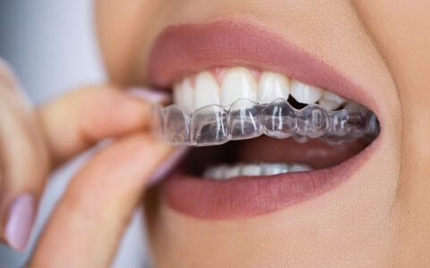 Clear aligners