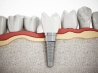 What You Should Know About Full Mouth Dental Implants