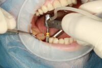 most affordable dental implants