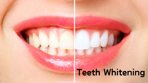 Teeth Whitening