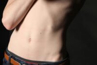 Is a Mini Tummy Tuck Right for You